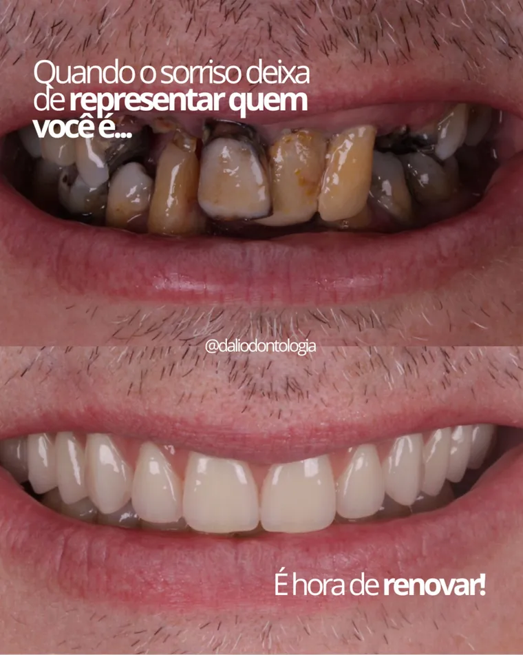 Antes e depois de reabilitação oral completa — caso real da Dalí Odontologia